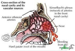 خونریزی مکرر از بینی