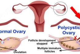 درمان تخمدان های PCO