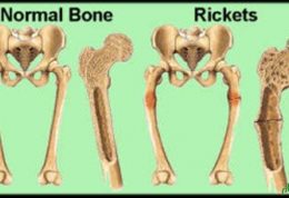 راشیتیسم و نحوه برطرف کردن آن