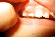 آبسه دندان و این تاثیرات منفی