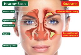سینوزیت را اینگونه برطرف کنید