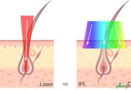 توضیحاتی پیرامون لیزر IPL