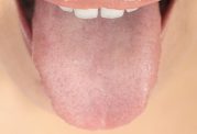 عارضه های مربوط به  دهان و دندان
