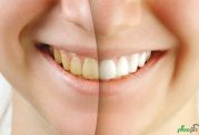 سفید کردن دندان بله یا خیر؟