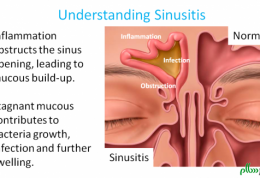 سینوزیت و راهکارهای موثر درمانی آن