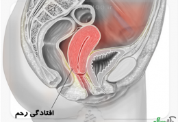 پیشگیری و درمان افتادگی رحم