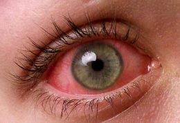 درمان های مختلف برای حساسیت چشمی