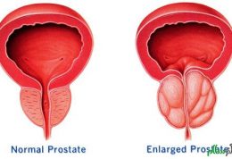 ندانسته هایی از سرطان پروستات که باید بدانید