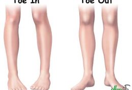 علل ایجاد بیماری پای پرانتزی