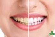 دندان های خود را سفید و شفاف کنید
