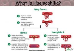 بررسی نشانه های هموفیلی