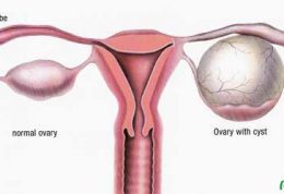 تشخیص وجود کیست تخمدان با این روش ها