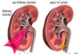 کمک لیزر برای دفع سنگ کلیه