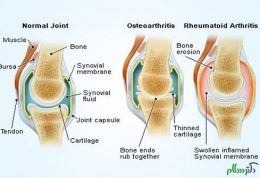 عوامل تاثیرگذار بر ایجاد آرتروز