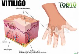 بررسی عارضه ویتیلیگو