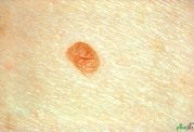 پیوند اعضا خطر ابتلا به سرطان پوست را افزایش می دهد