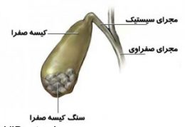 افرادی که دچار سنگ کیسه صفرا هستند مطالعه کنند