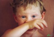 بیماری کاوازاکی در کودکان زیر پنج سال