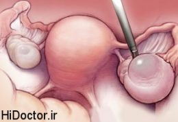 همه کیست های تخمدان بدخیم نیستند!