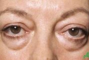 تفاوت بین التهاب اطراف چشم