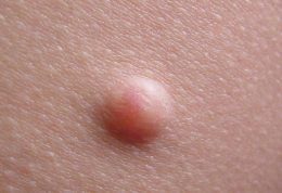سرطان پوست در 10 ناحیه غیر معمول