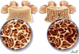 ایجاد پوکی استخوان در مردان