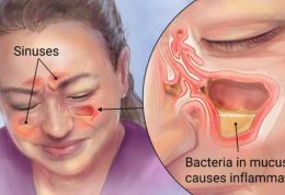 درمانی متفاوت برای سینوزیت