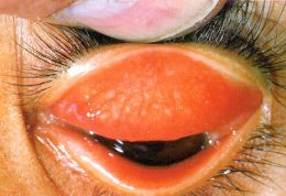 نشانه های خطرناک تراخم در چشم ها