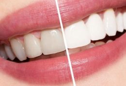 تغییر رنگ دندان ها با این 9 عامل آب زیرکاه
