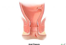 بررسی انواع شقاق مقعد و راههای درمانی خانگی و پزشکی