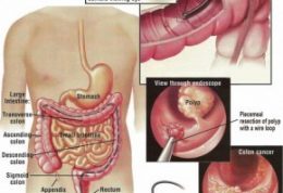 همه چیز درباره کولونوسکوپی