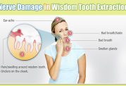 گرفتاری های مربوط به دندان عقل