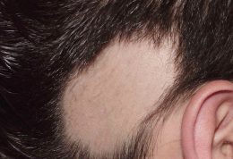 درباره ریزش مو از نوع تاسی منطقه ای بیشتر بدانید