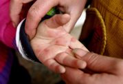 حقایقی در مورد بیماری های دست و پا و دهان کودکان