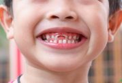 تاثیر مواد قندی بر پوسیدگی دندان