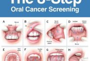 عوامل تاثیرگذار بر ایجاد سرطان دهان