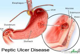 مقابله و درمان به موقع زخم معده
