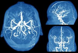 خطرات جانبی آنوریسم مغزی را بشناسید
