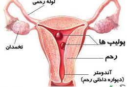 درمان های نوین برای رفع توده های پولیپی و فیبرومی