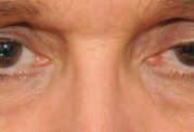 درمان افتادگی پلک چشم با روش های علمی