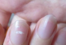 چرا بر روی ناخن مان لکه های سفید بوجود می آیند؟