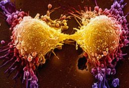 نشانه های سرطان پروستات کدامند؟