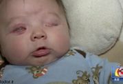 شیوع تولد نوزادان بدون چشم,چرا و چگونه؟