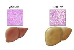 کبدتان چرب است؟پس این توصیه های طب سنتی را بخوانید