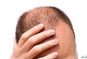 روش های موثر برای درمان ریزش مو در مردان