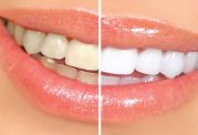 فوت و فن های ساده برای سفید کردن دندان ها