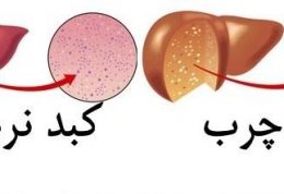 احتمال بیماری کبد چرب در چه افرادی بیشتر است؟