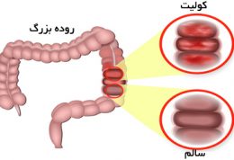 تغذیه مناسب برای بیماران کولیت السروز