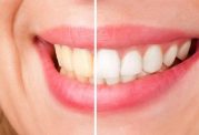 موثر ترین راه برای سفید کردن طبیعی دندان ها