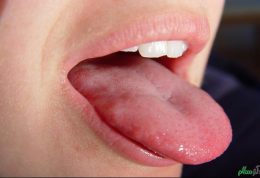 بیماری التهاب زبان یا گلوسیت چیست؟